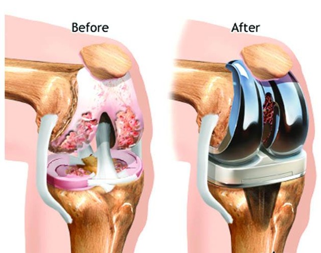 TOTAL KNEE REPLACEMENT:
A surgical procedure to resurface a knee damaged by arthritis. Metal and plastic parts are used to cap the ends of the bones that form the knee joint, along with the kneecap. This surgery is often the choice for someone who has severe arthritis.
Various types of arthritis may affect the knee joint, including Osteoarthritis, Rheumatoid arthritis, or Traumatic arthritis, can create breakdown of the cartilage in the knee. The goal of knee replacement surgery is to resurface the parts of the knee joint that have been damaged and to relieve knee pain that cannot be controlled by other treatments.
Good physical therapy is the key for a long-term successful result after knee replacement surgery. Restoring your range of motion and strength allows you to return to the things you were missing out on because of knee pain. #SportsPlusPT #TryPTFirst #Call6417536636