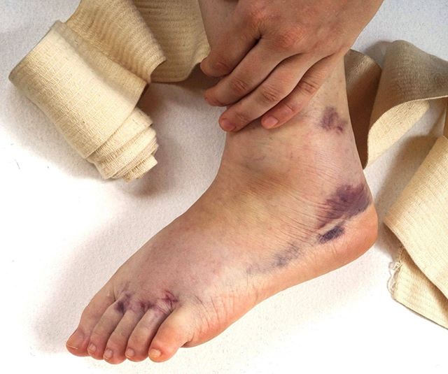 ANKLE SPRAIN: A sprain occurs when your ankle is forced to move out of its normal position, which can cause one or more of the ankle's ligaments to stretch, partially tear or tear completely. 
Causes of a sprained ankle might include a fall that caus