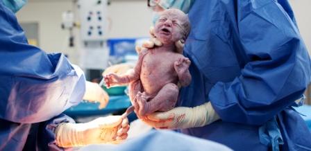 DVcesareanbirth_compressed.jpeg