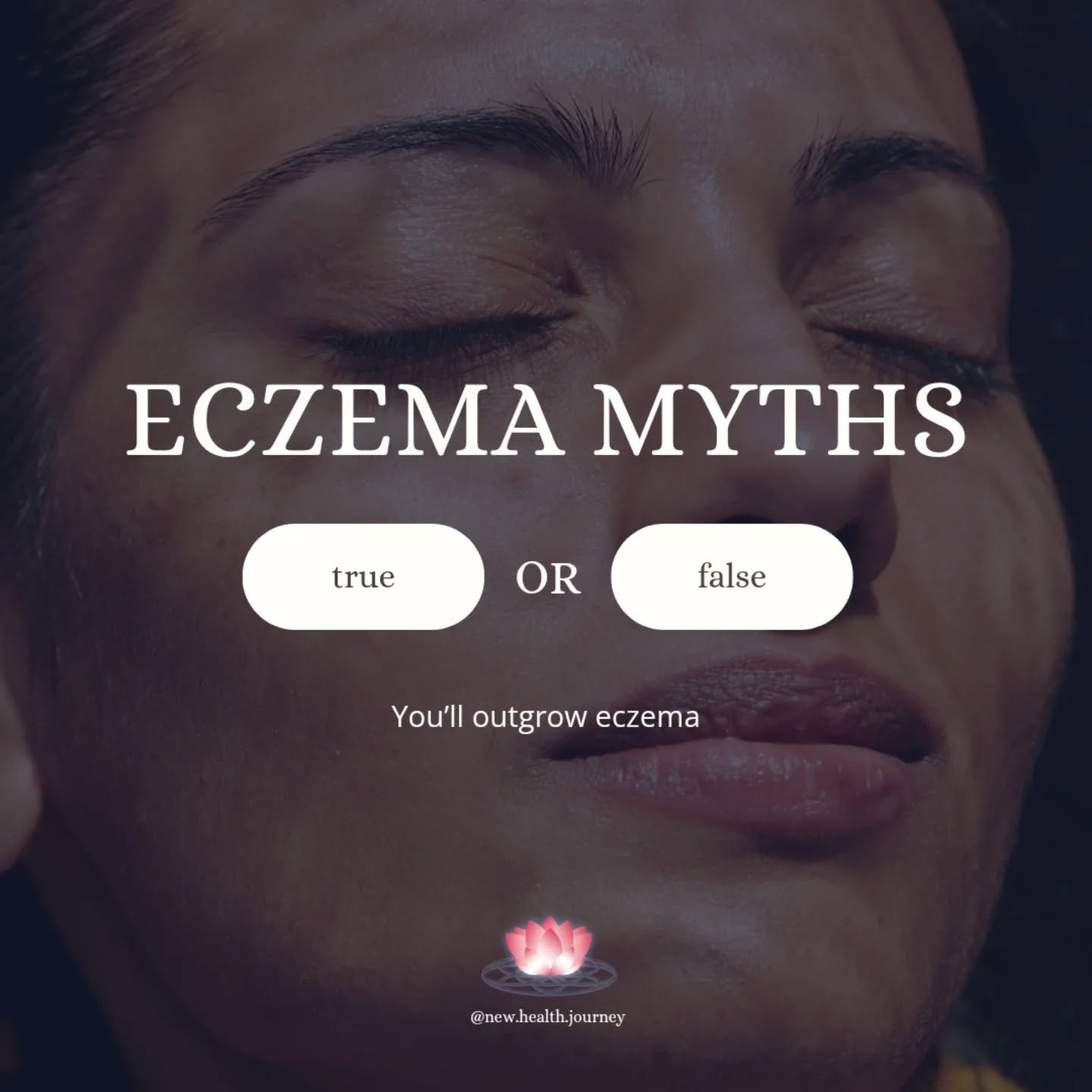 Myth #3: You&rsquo;ll Outgrow Eczema

❌ MYTH: &ldquo;Eczema is just for kids. You&rsquo;ll outgrow it.&rdquo;

✅ FACT: While some kids do outgrow eczema, many adults still struggle with flare-ups. There is child and adult onset eczema, and as adults,