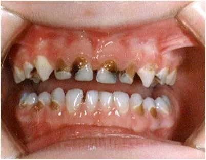 Where do cavities come from?