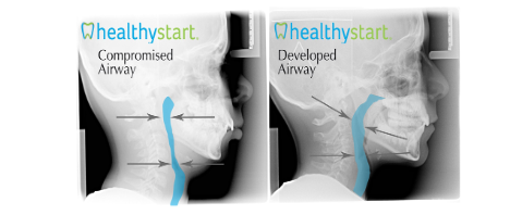 Healthy Airway for a Healthy Start