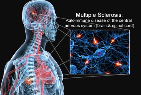 multiple-sclerosis-s1-brain-spinal-cord-nerves.jpg