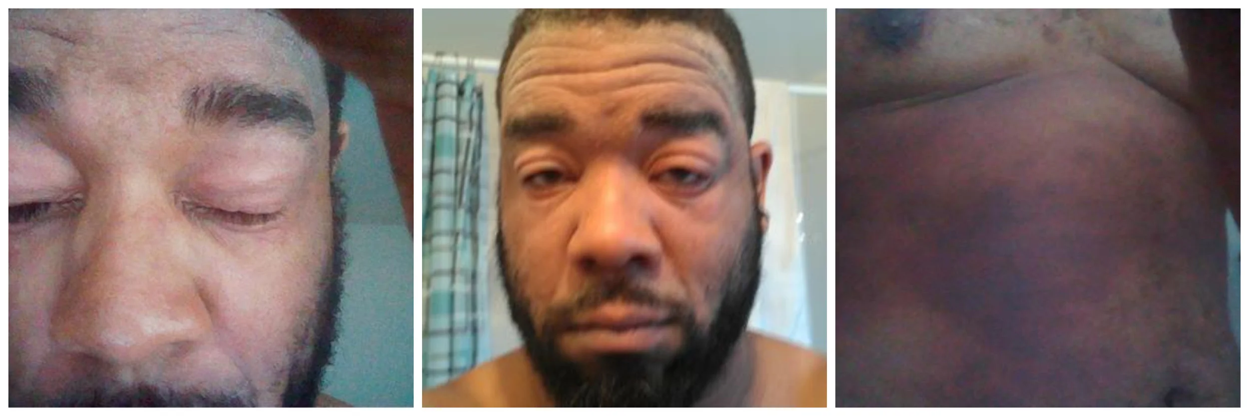 rash.jpg