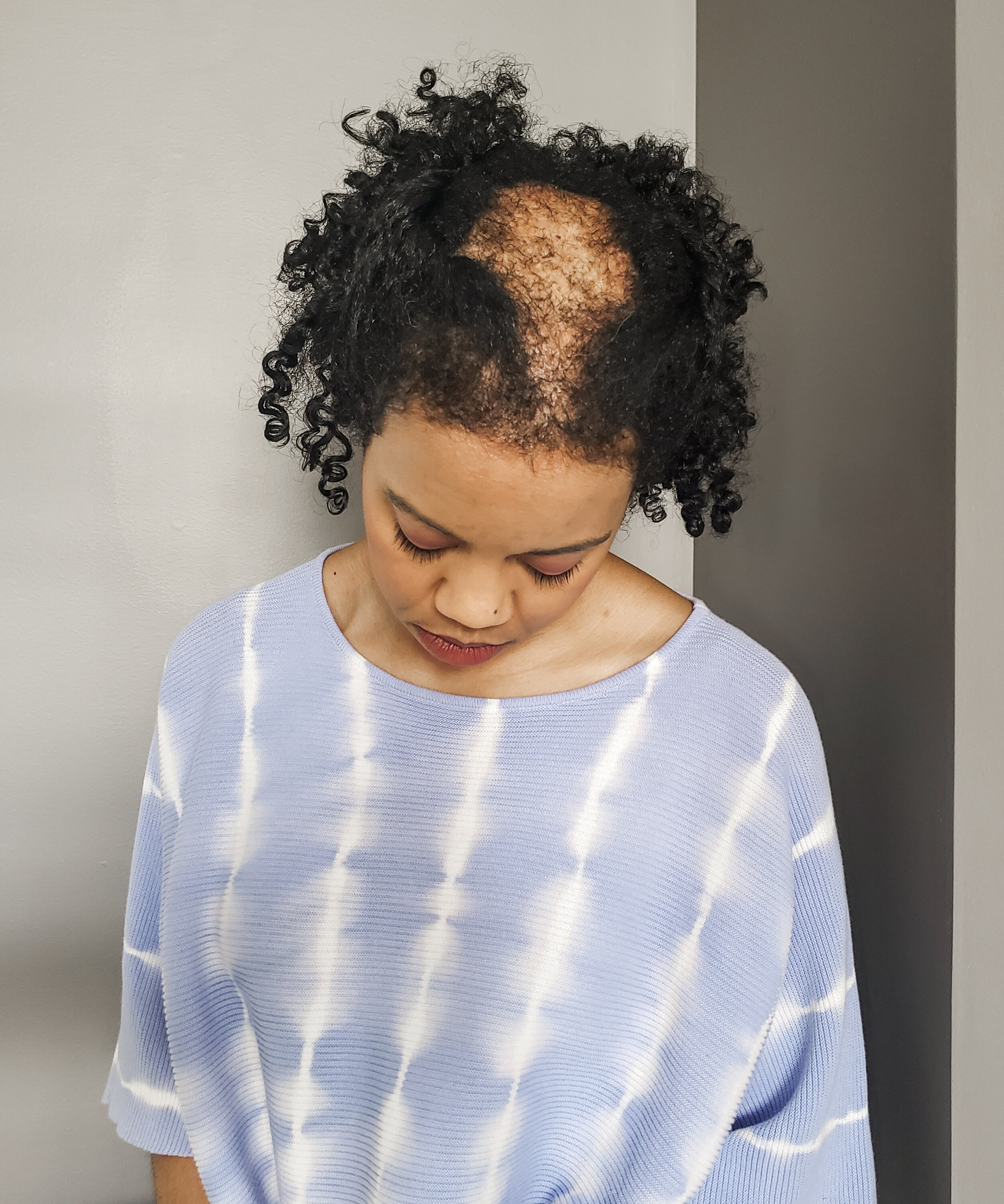 Scarring Alopecia Chronic Hair Loss Is Prevalent Amongst Black Women Nola Johnson Shares How Her Hair Loss Journey Led Her To Homeopathic Healthcare Melaninass Com