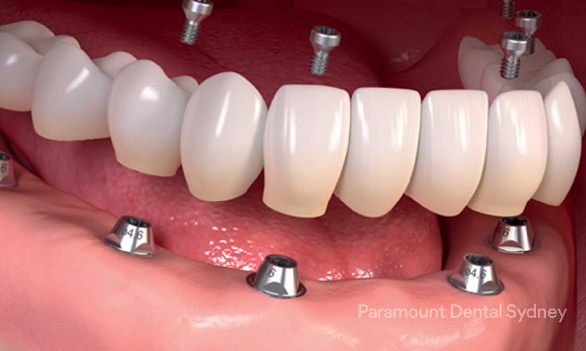 © Paramount Dental Sydney Full Mouth Dental Implants 2.jpg