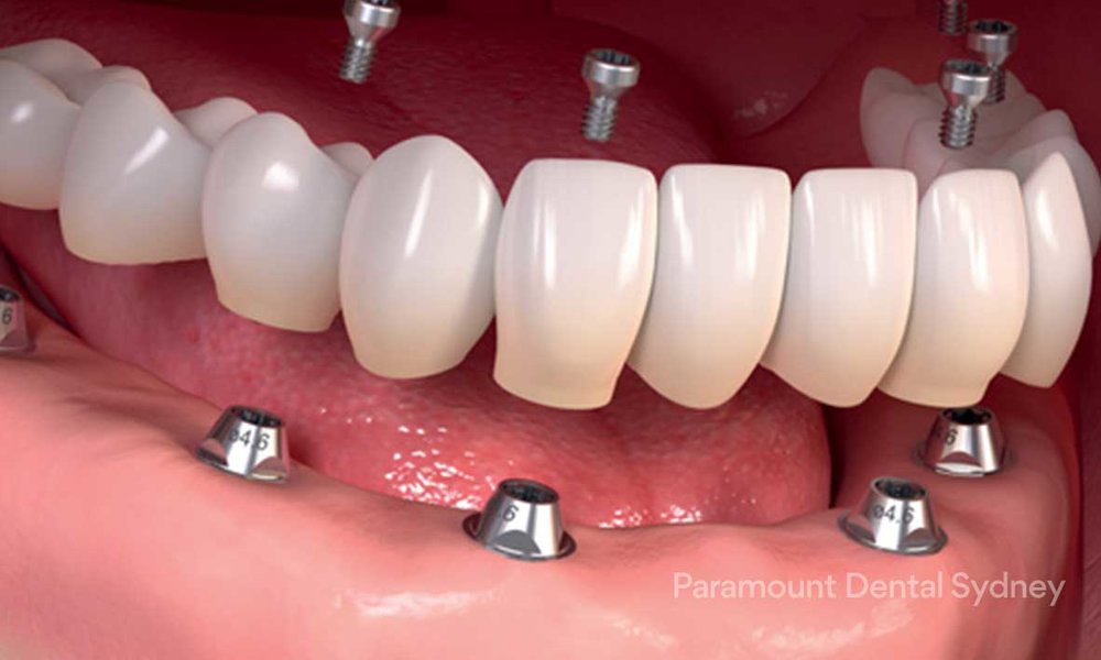 Full Mouth Dental Implants | Paramount Dental Sydney CBD — Paramount Dental  Sydney