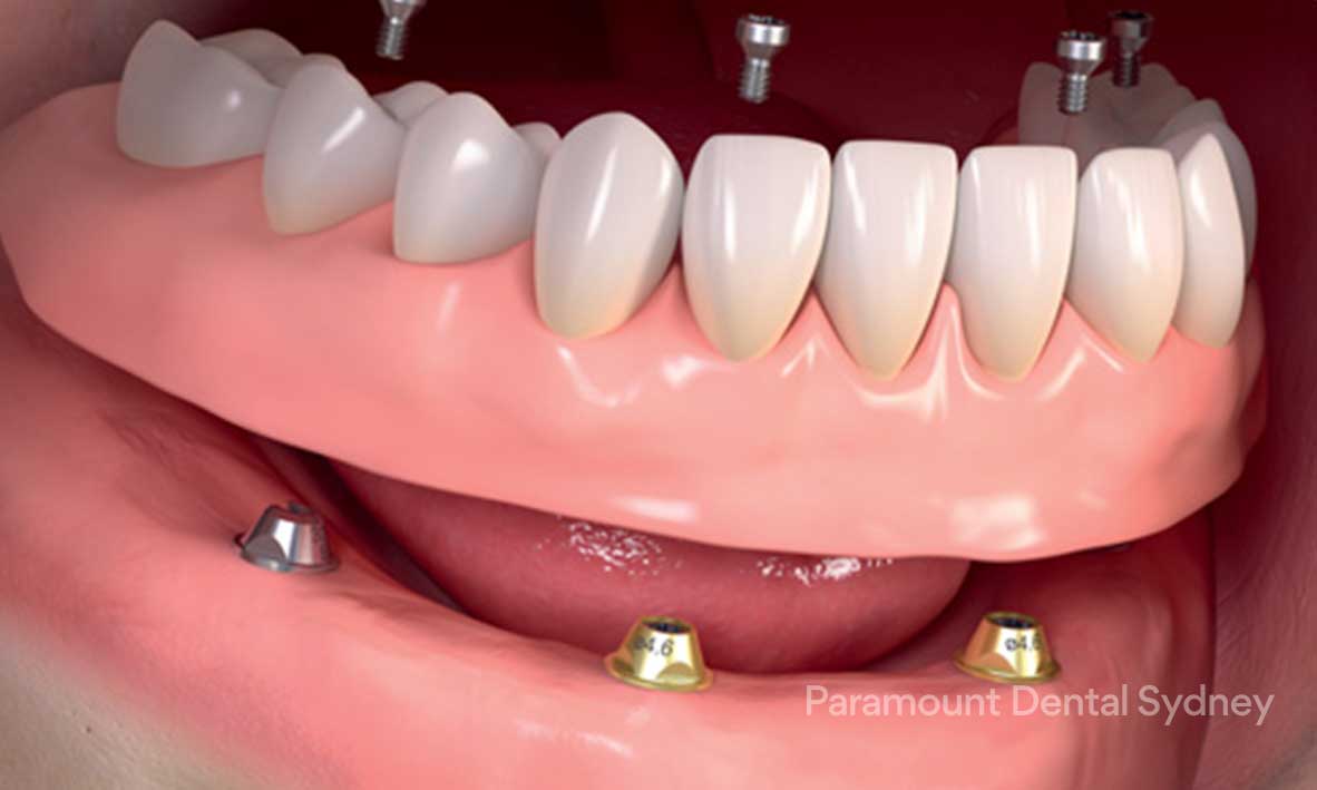 © Paramount Dental Sydney Full Mouth Dental Implants 1.jpg