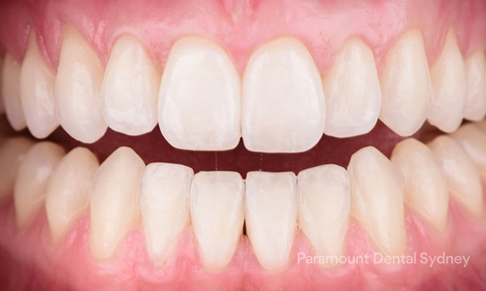 Laser Gum Bleaching | Paramount Dental Sydney CBD — Paramount Dental Sydney