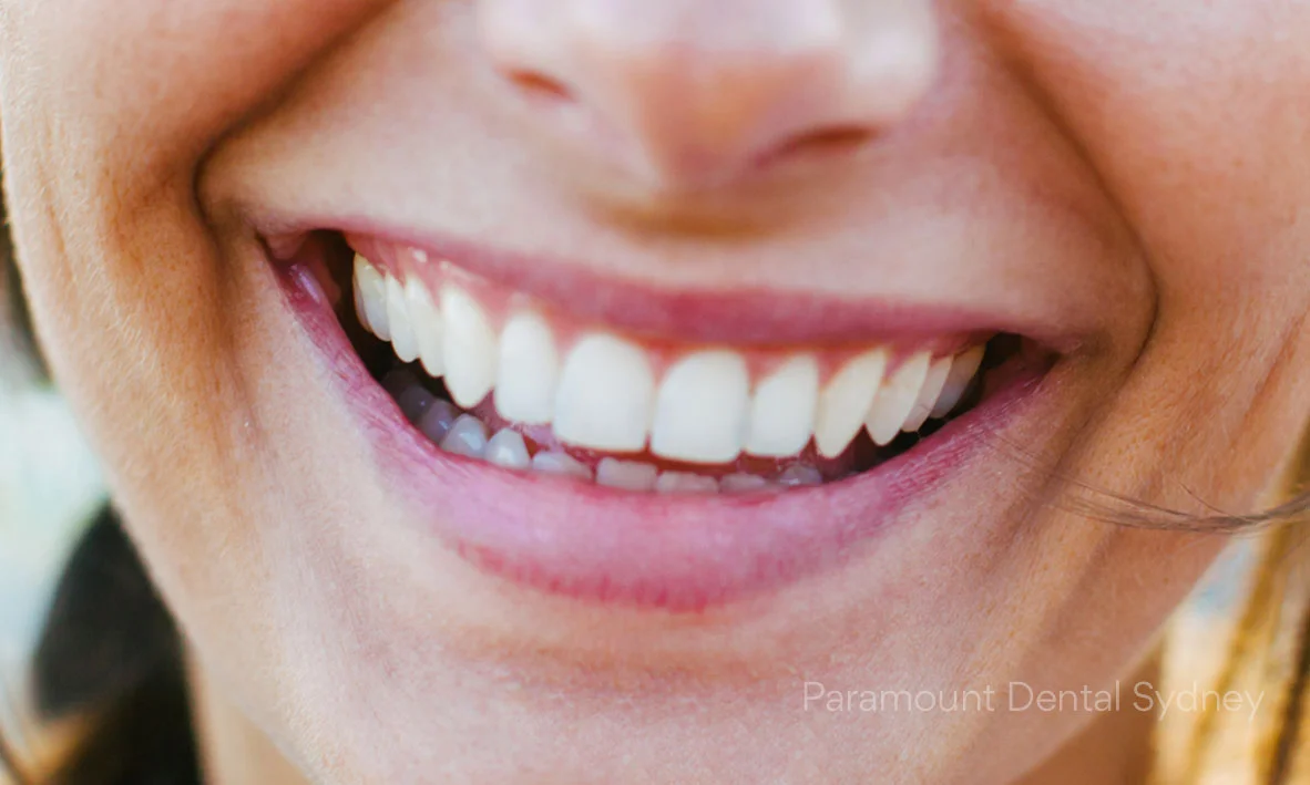 Teeth Whitening Doesn’t Destroy Enamel — Paramount Dental Sydney