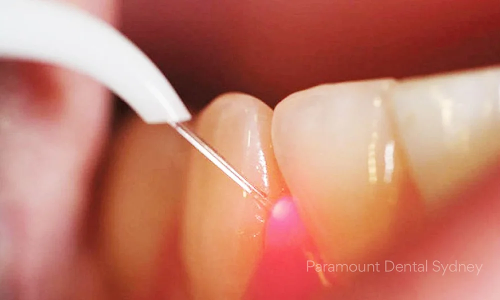 The Difference Between Laser Traditional Root Canal Treatment Paramount Dental Sydney