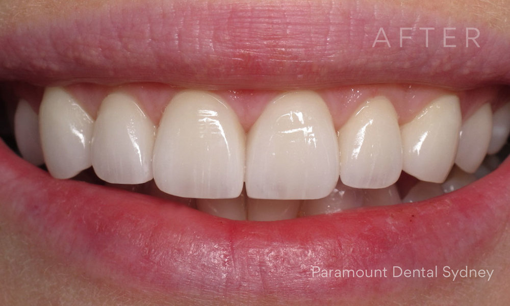 © Paramount Dental Sydney Veneers Before and After 2 After.jpg