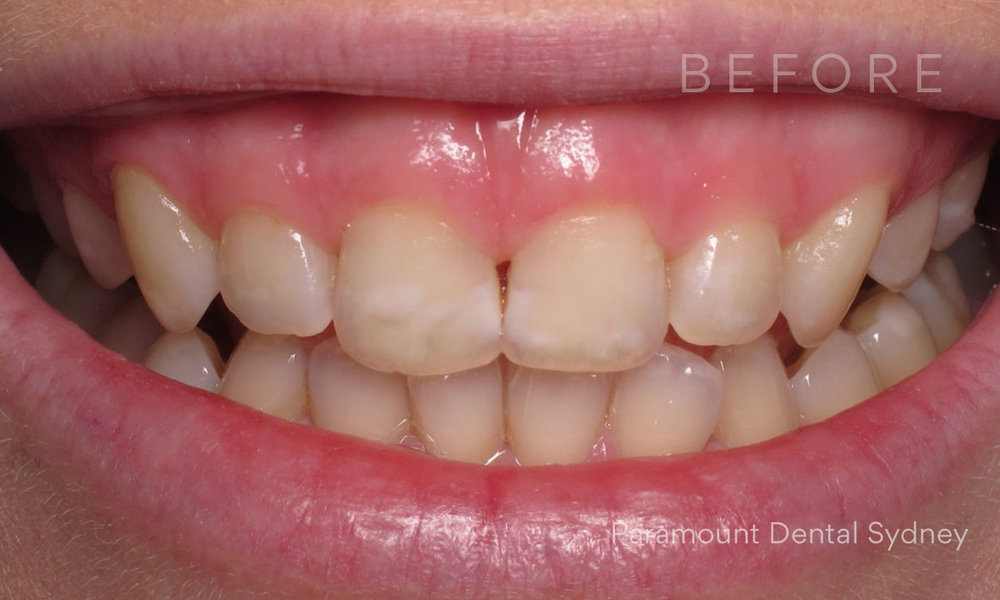 © Paramount Dental Sydney Veneers Before and After 2 Before.jpg
