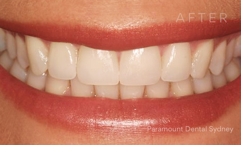 © Paramount Dental Sydney Veneers Before and After 3 After.jpg