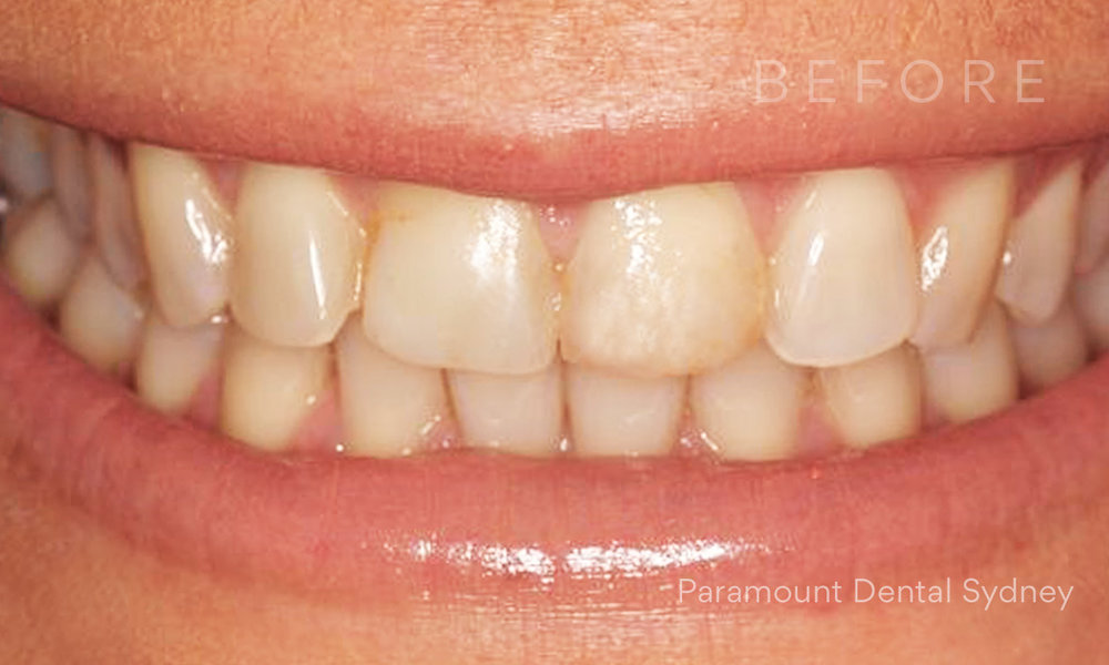 © Paramount Dental Sydney Veneers Before and After 3 Before.jpg