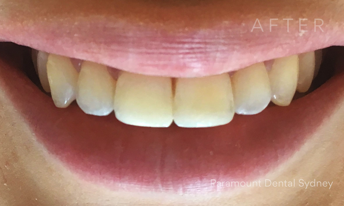 © Paramount Dental Sydney Veneers Before and After 4 After.jpg