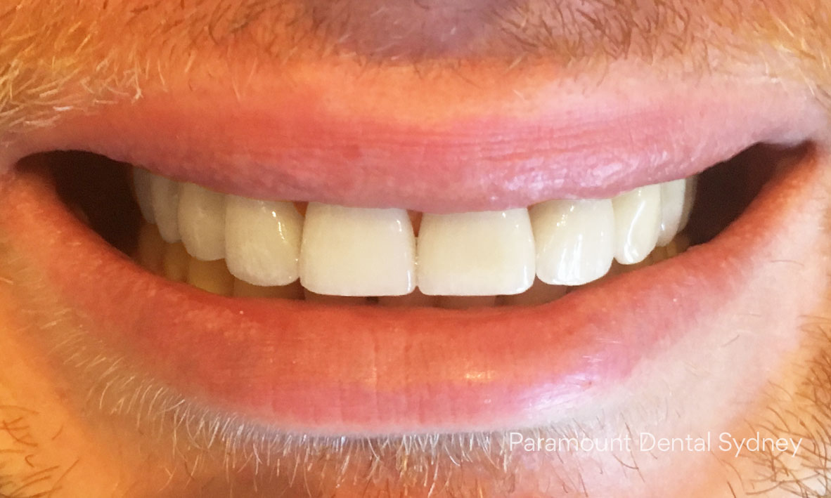  After:&nbsp; Porcelain Veneers &nbsp;and  Whitening &nbsp;on bottom teeth 