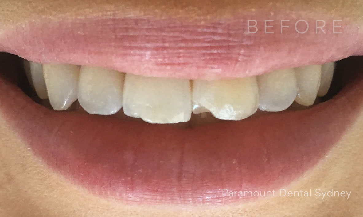 © Paramount Dental Sydney Veneers Before and After 4 Before.jpg