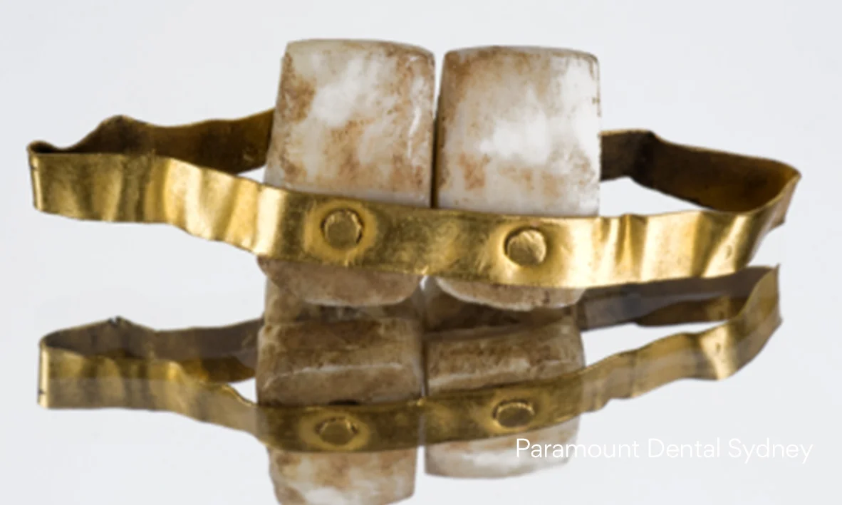Gold Teeth Through the Ages — Paramount Dental Sydney