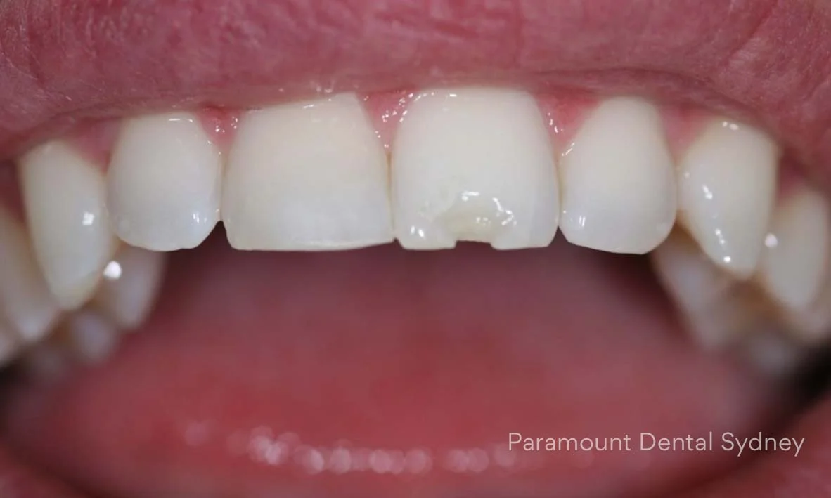 Cracked, Chipped & Broken Teeth Paramount Dental Sydney — Paramount