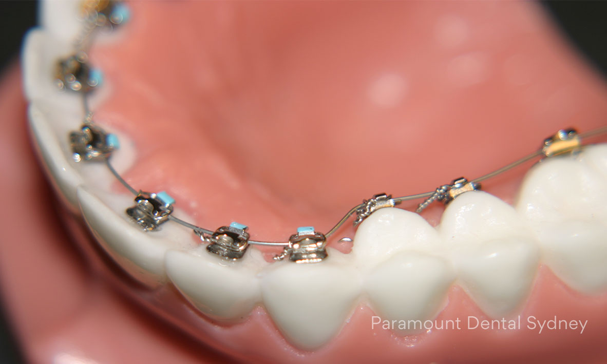 Lingual Braces - Inside Braces  Paramount Dental Sydney CBD
