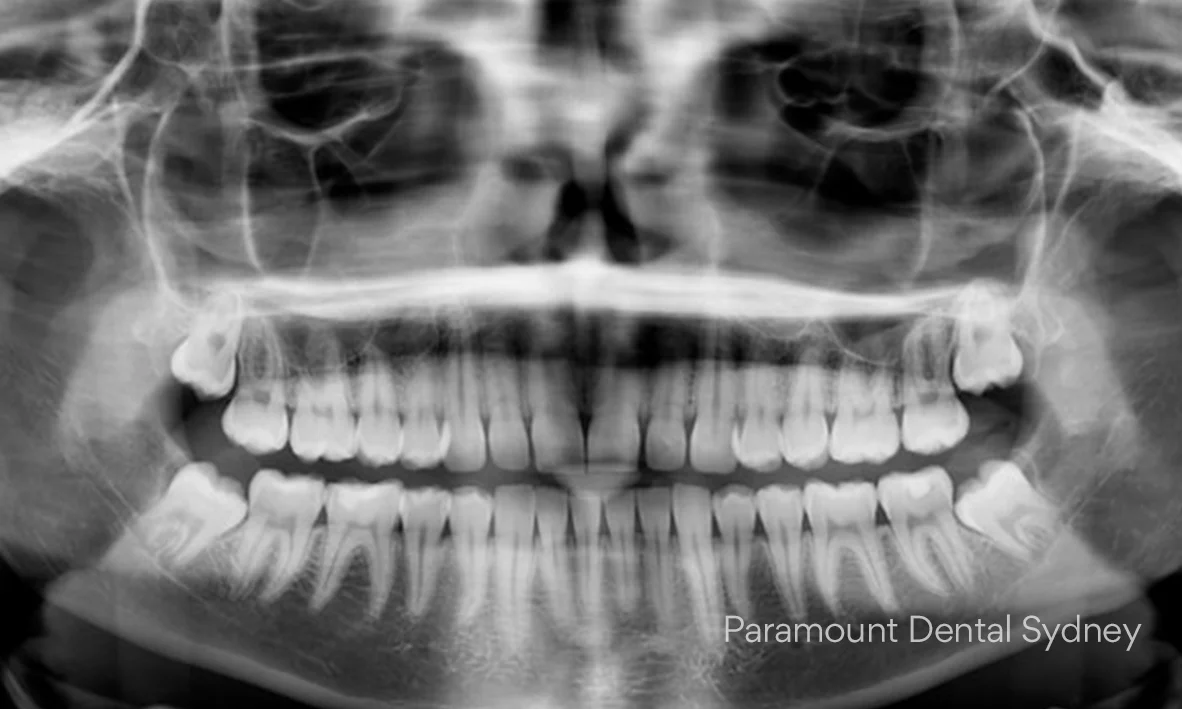 A Guide to Dealing Wisdom Teeth — Paramount Dental Sydney