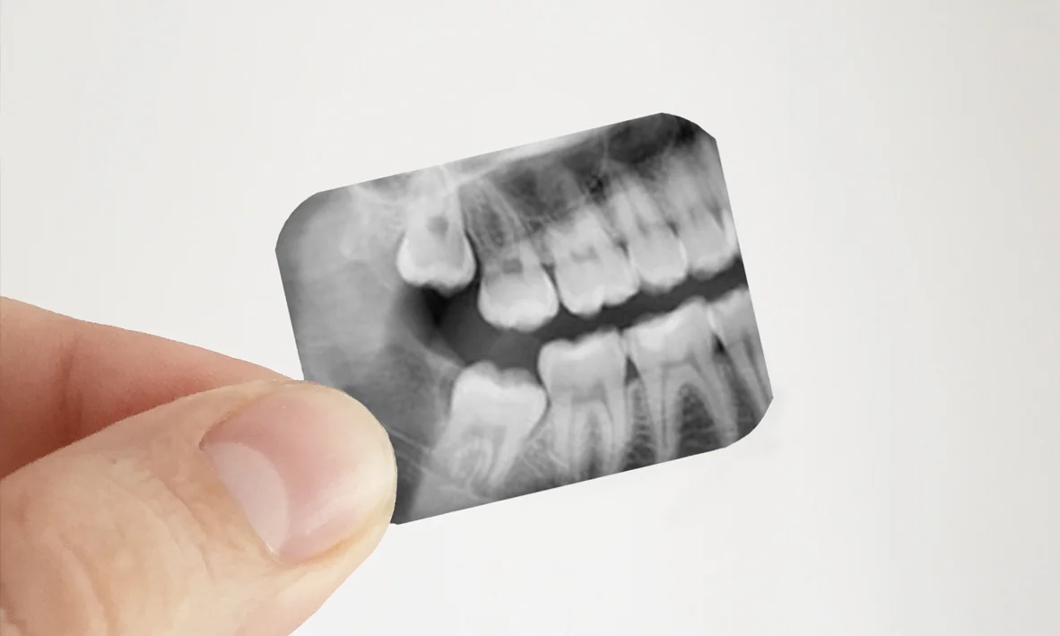 A Guide to Dealing Wisdom Teeth — Paramount Dental Sydney