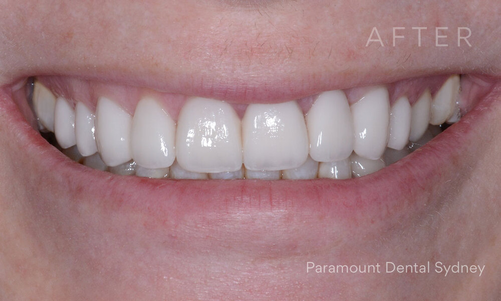 ©-Paramount-Dental-Sydney-Porcelain-Veneers-Before-and-After-11-Before.jpg
