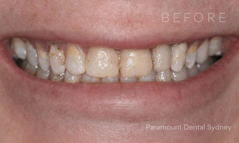 ©-Paramount-Dental-Sydney-Porcelain-Veneers-Before-and-After-11-After.jpg