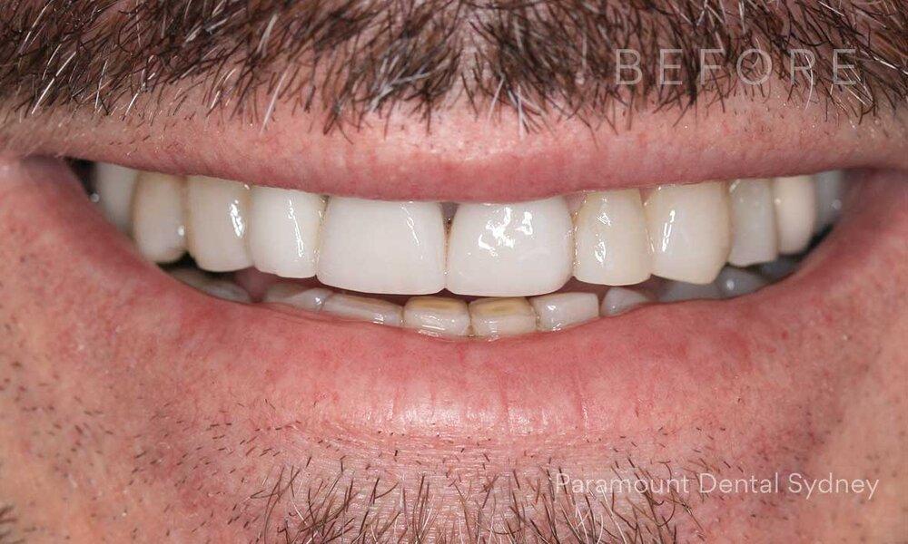 ©-Paramount-Dental-Sydney-Porcelain-Veneers-Before-and-Before-12.jpg