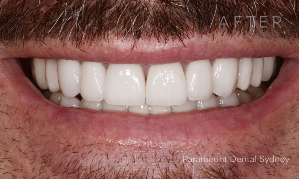 ©-Paramount-Dental-Sydney-Porcelain-Veneers-Before-and-After-12.jpg