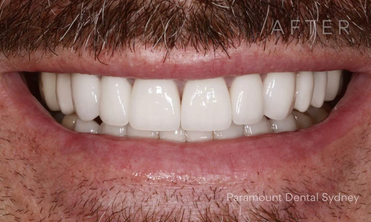 Have You Heard of Pulp Extirpation? — Paramount Dental Sydney