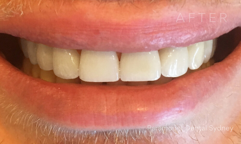 © Paramount Dental Sydney Veneers Before and After 5 After.jpg
