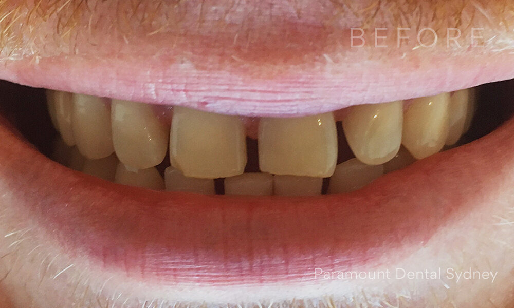 © Paramount Dental Sydney Veneers Before and After 5 Before.jpg
