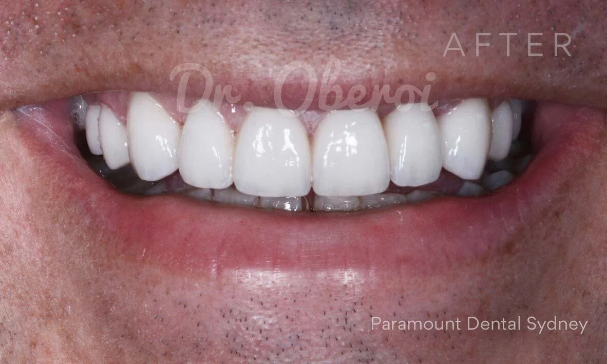 Smile Gallery - Dental Care — Paramount Dental Sydney