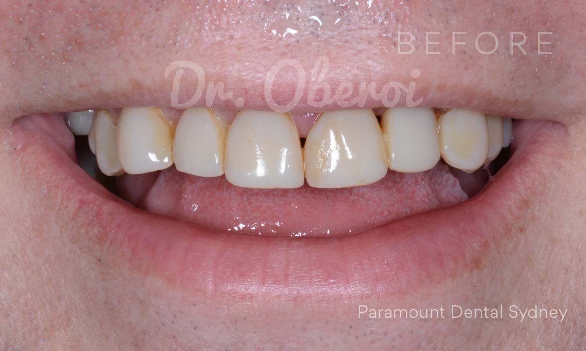 ©-Paramount-Dental-Sydney-Porcelain-Veneers-Before-and-After-13 A.jpg
