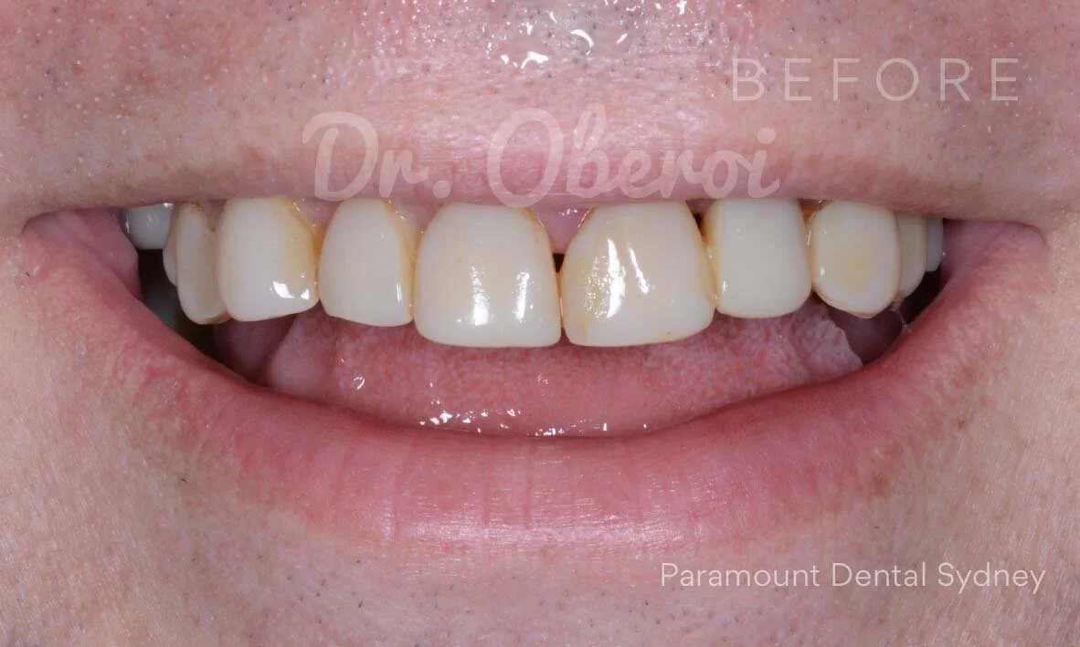 Have You Heard of Pulp Extirpation? — Paramount Dental Sydney