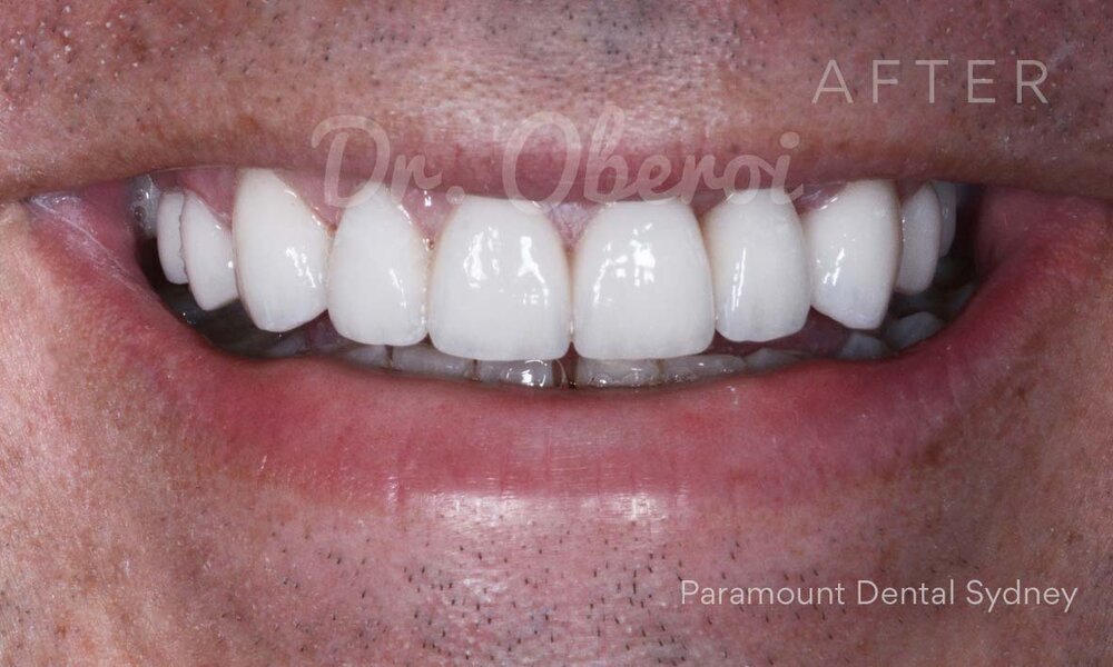 ©-Paramount-Dental-Sydney-Porcelain-Veneers-Before-and-After-13 B.jpg