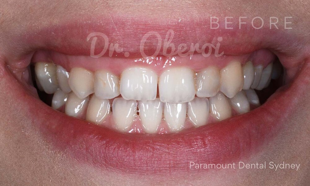©-Paramount-Dental-Sydney-Veneers-Before-and-After-11-Before.jpg