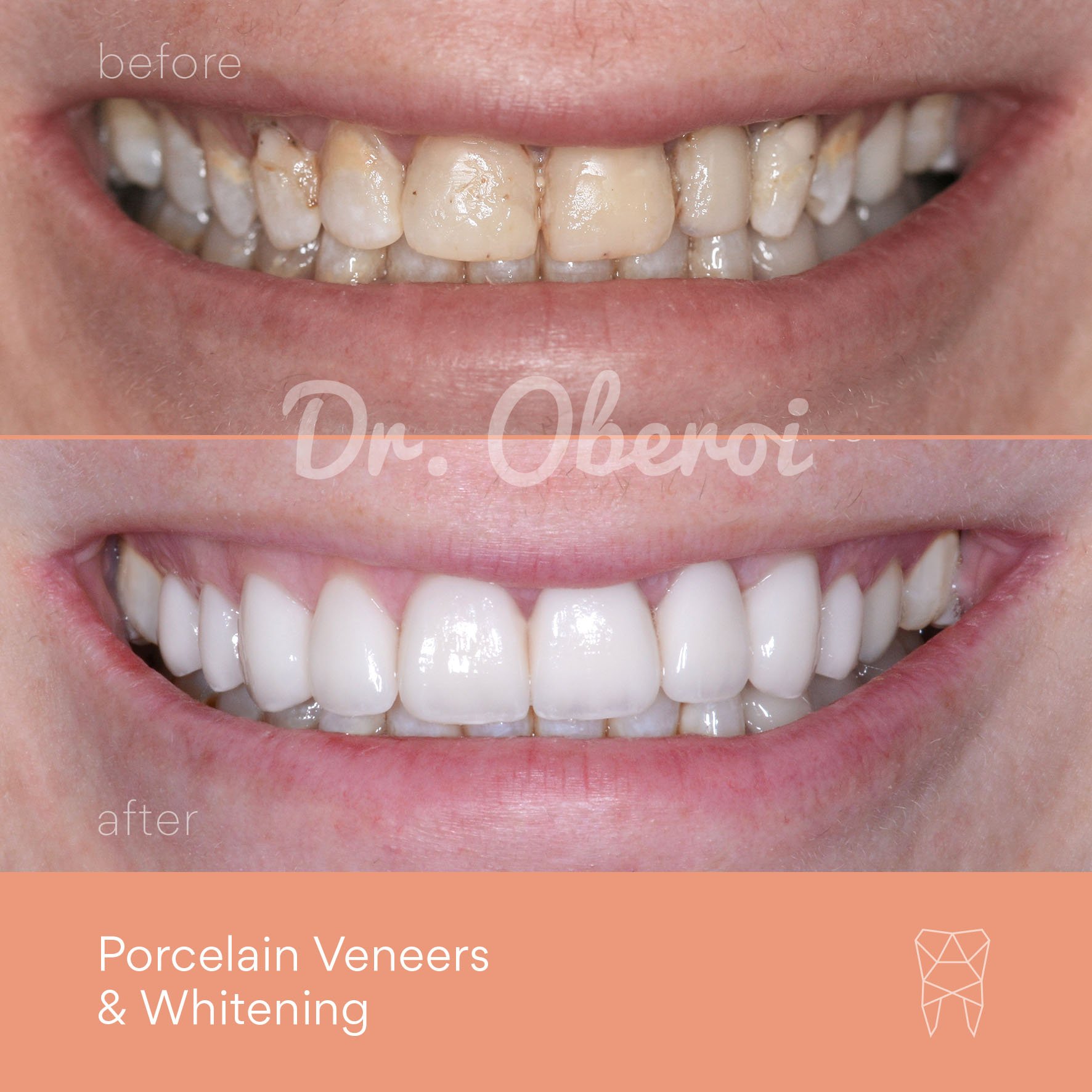 © PARAMOUNT DENTAL SYDNEY Porcelain Veneers before and after dentist 01.jpg