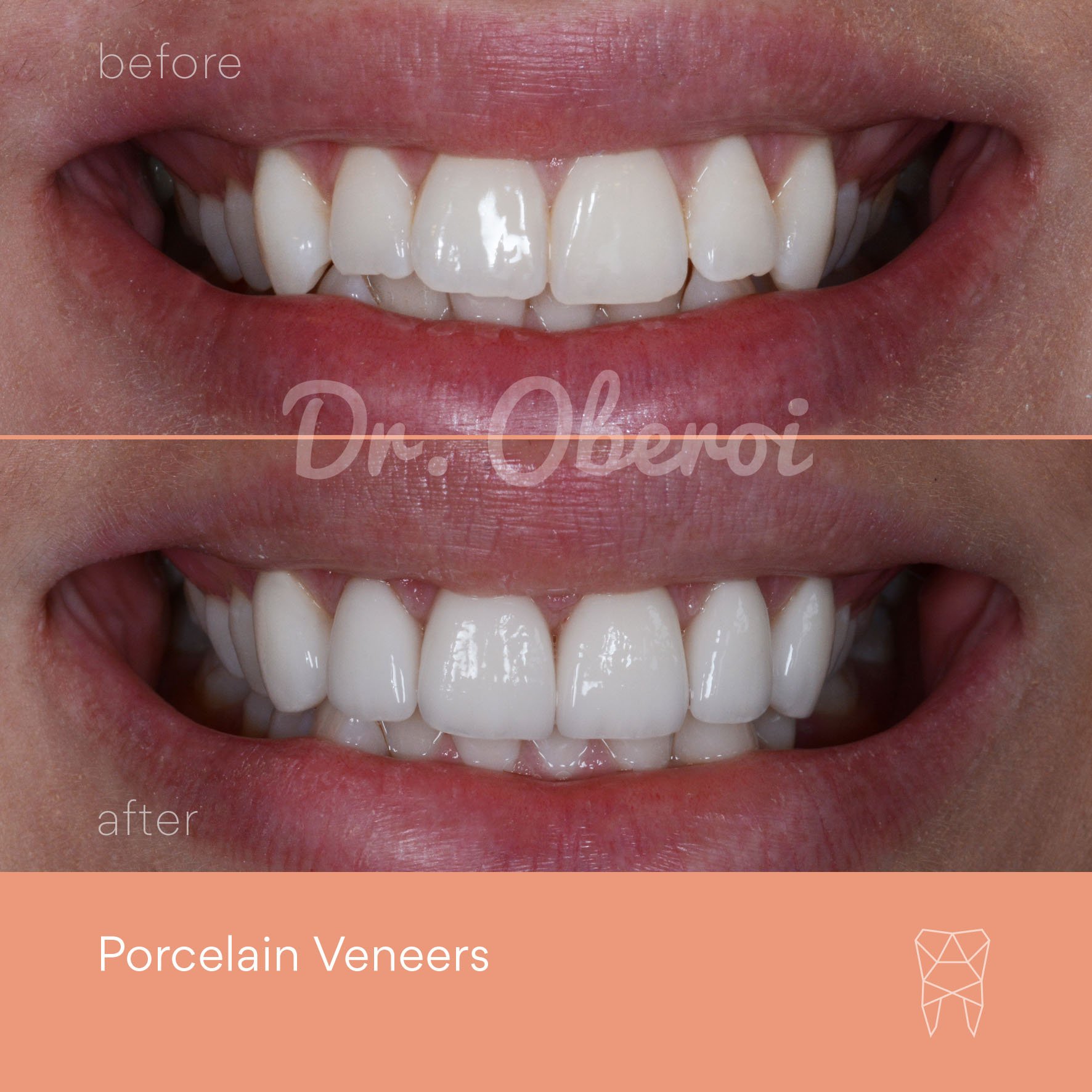 © PARAMOUNT DENTAL SYDNEY Porcelain Veneers before and after dentist 04.jpg