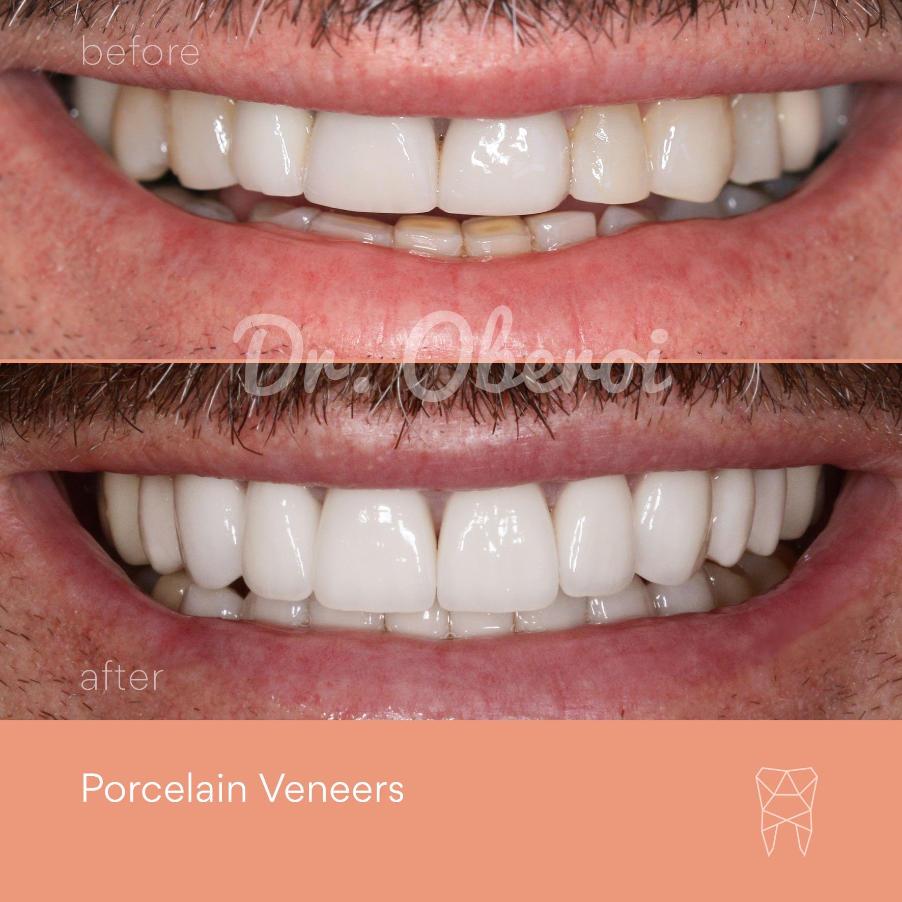 © PARAMOUNT DENTAL SYDNEY Porcelain Veneers before and after dentist 05.jpg