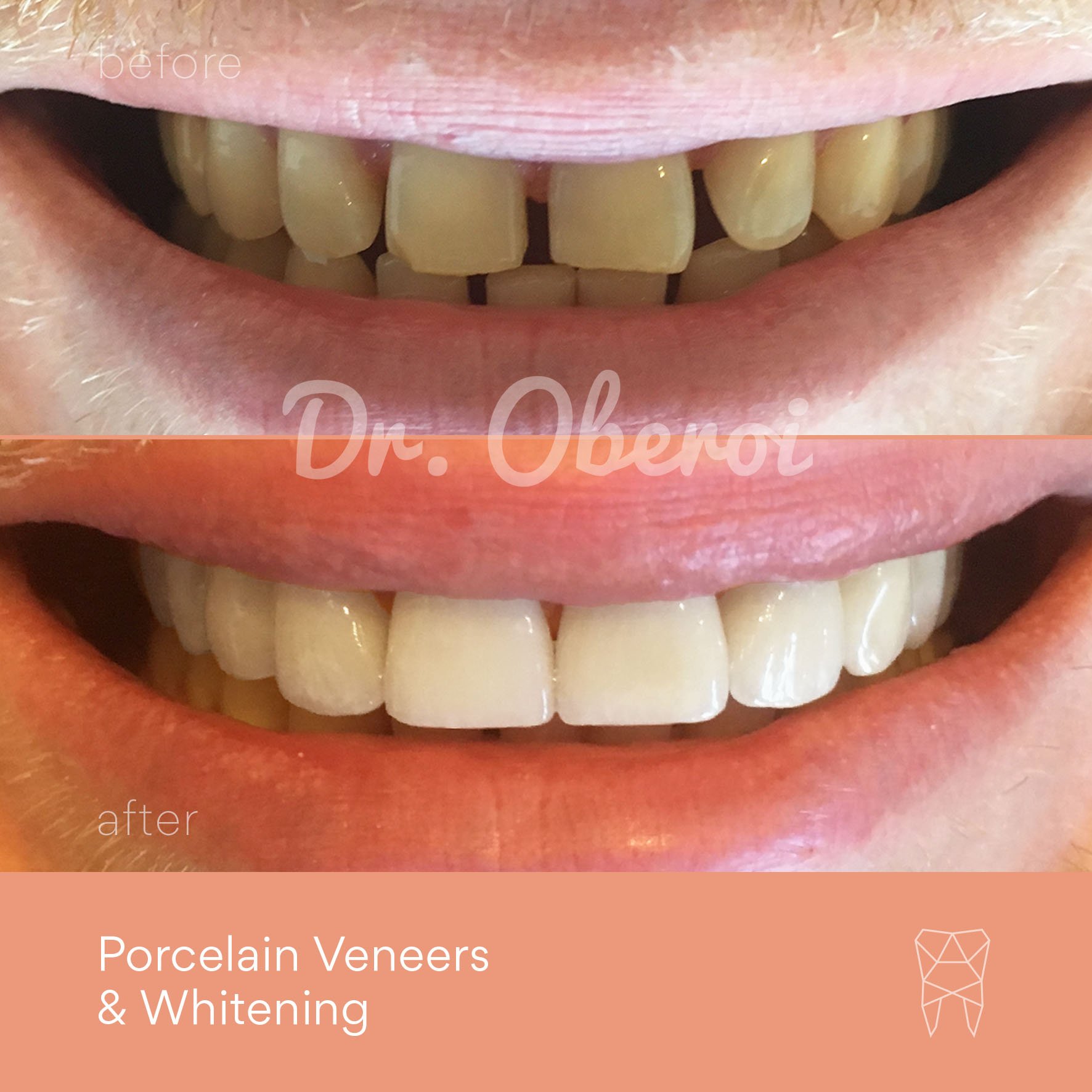 © PARAMOUNT DENTAL SYDNEY Porcelain Veneers before and after dentist 06.jpg