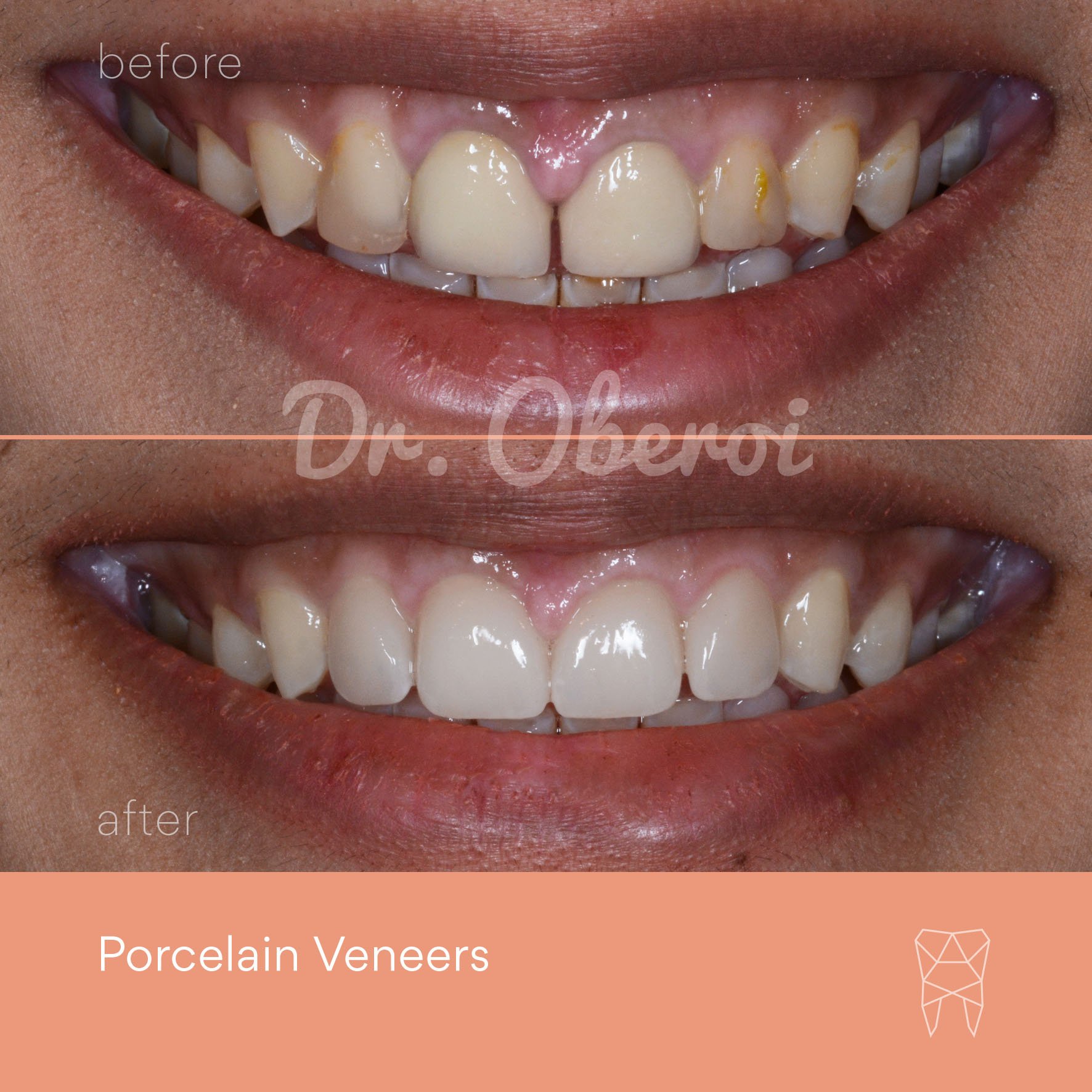 © PARAMOUNT DENTAL SYDNEY Porcelain Veneers before and after dentist 08.jpg
