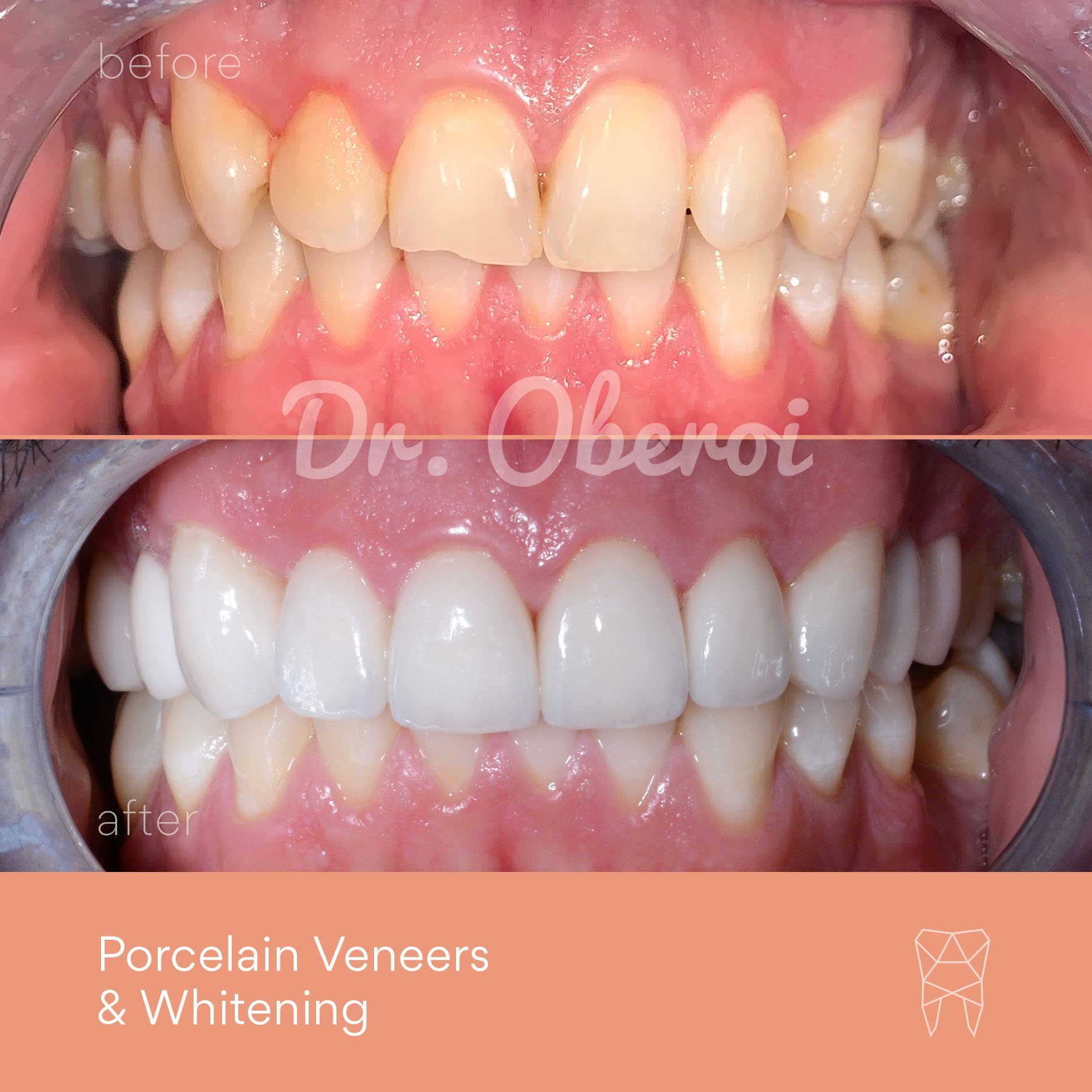 © PARAMOUNT DENTAL SYDNEY Porcelain Veneers before and after dentist 09.jpg