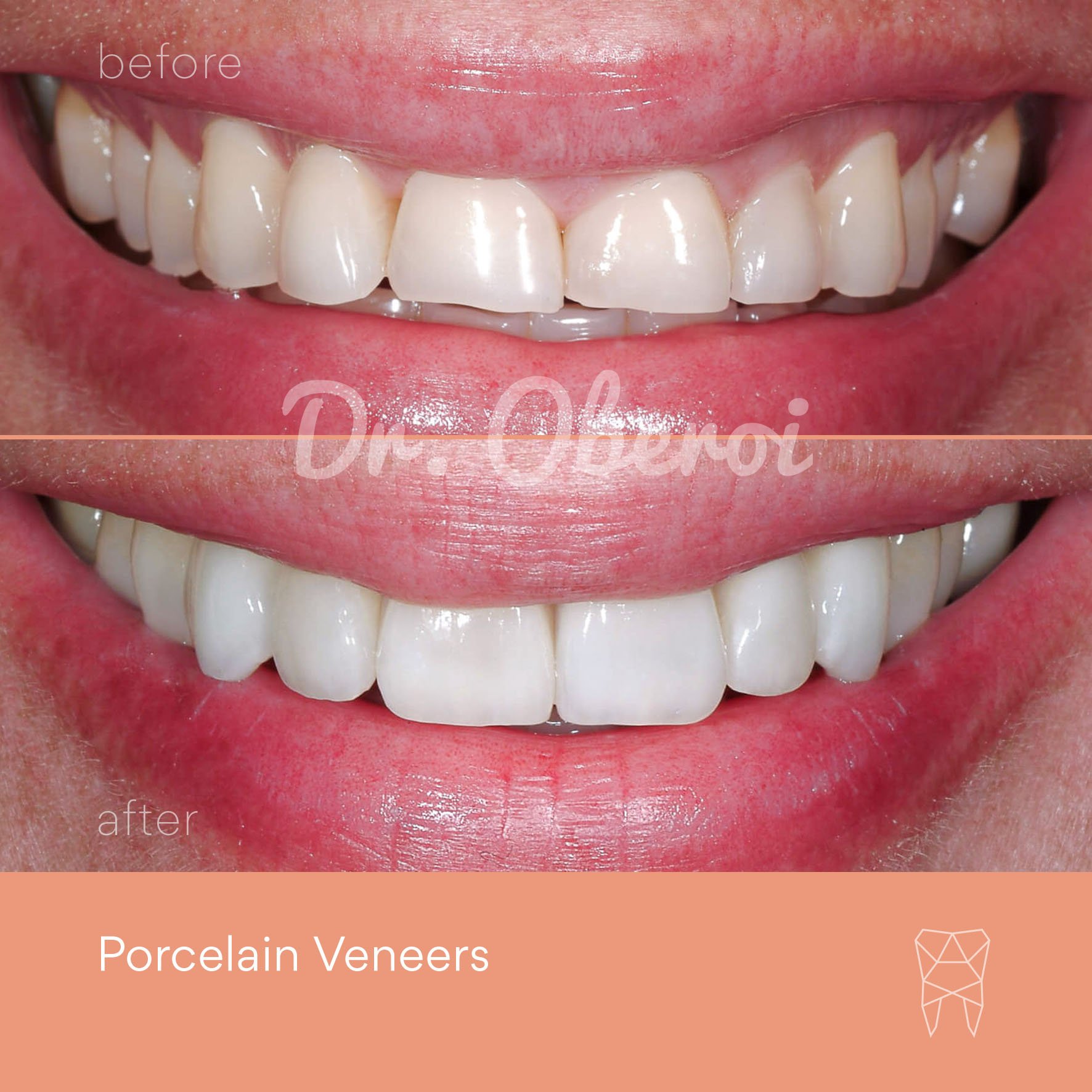 © PARAMOUNT DENTAL SYDNEY Porcelain Veneers before and after dentist 12.jpg