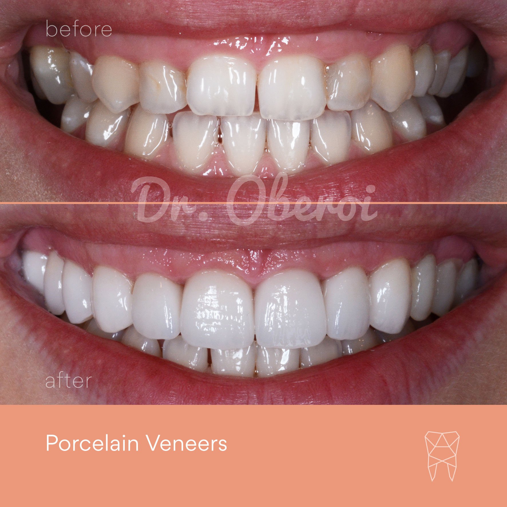 © PARAMOUNT DENTAL SYDNEY Porcelain Veneers before and after dentist 13.jpg