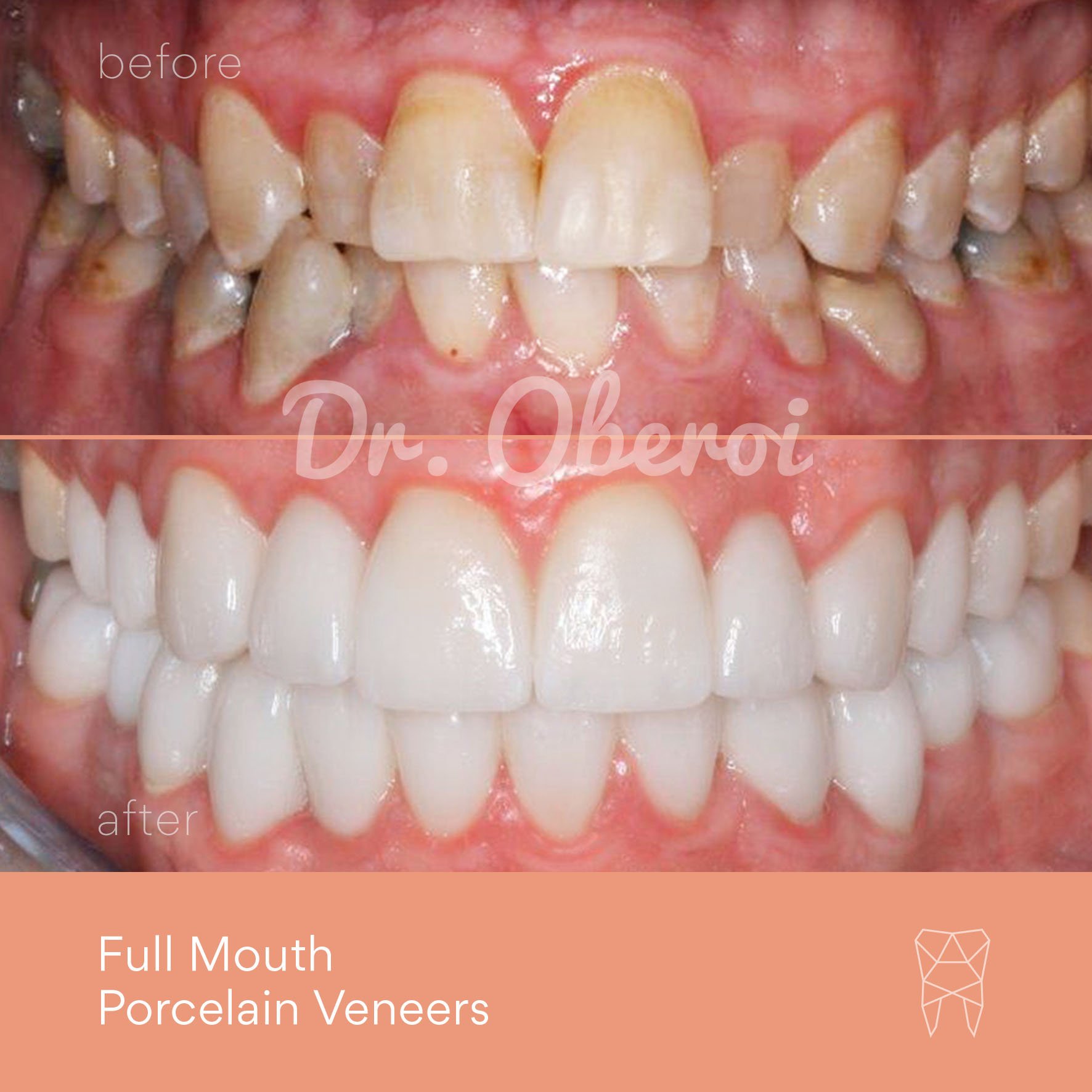 © PARAMOUNT DENTAL SYDNEY Porcelain Veneers before and after dentist 15.jpg