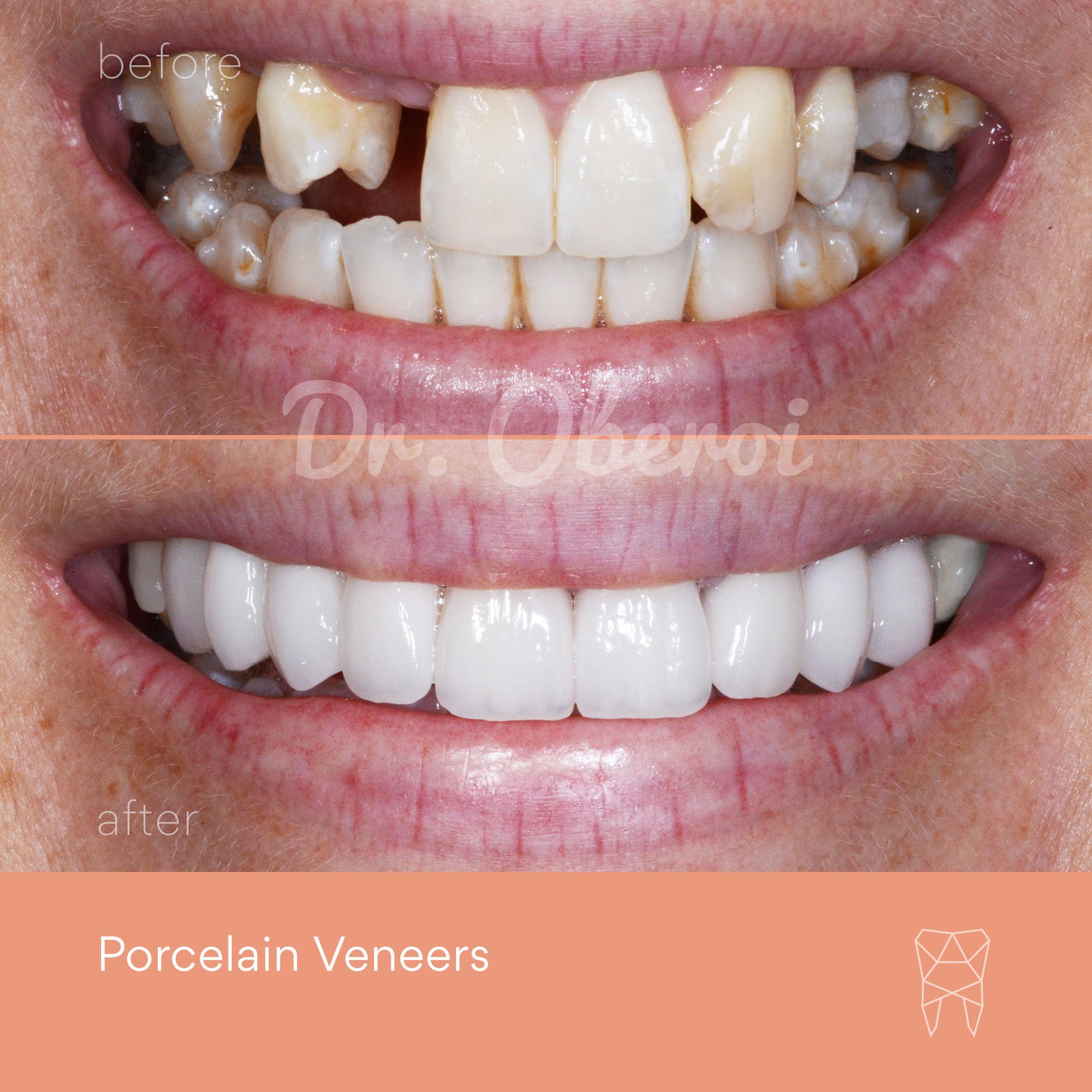 © PARAMOUNT DENTAL SYDNEY Porcelain Veneers before and after dentist 16.jpg