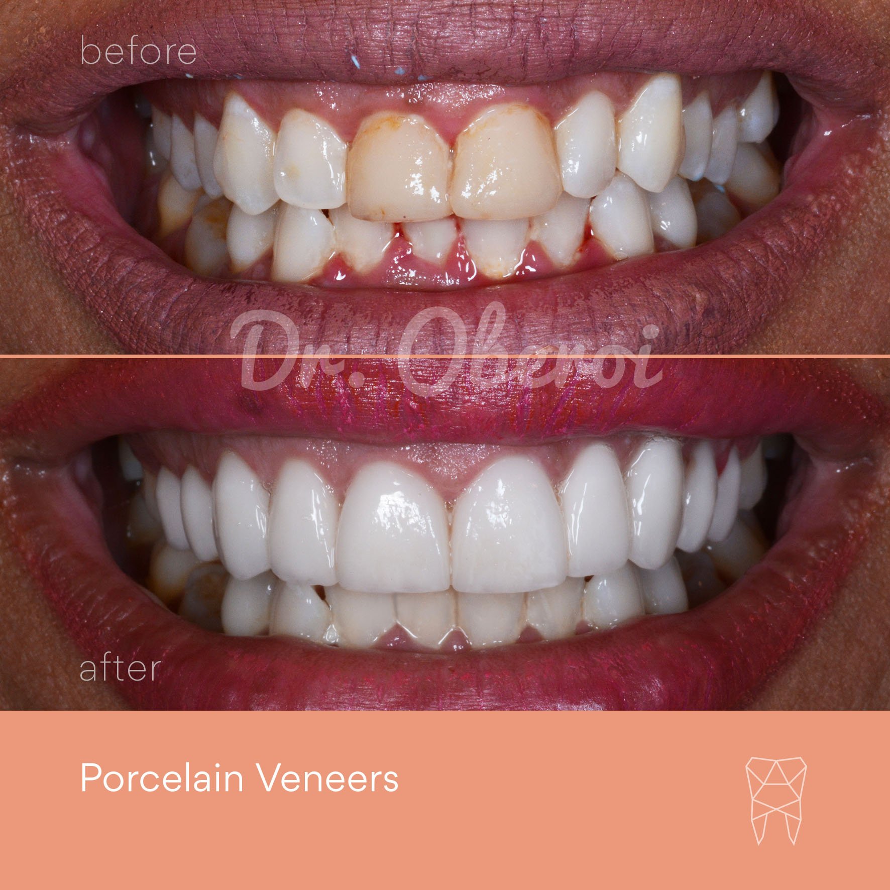 © PARAMOUNT DENTAL SYDNEY Porcelain Veneers before and after dentist 17.jpg